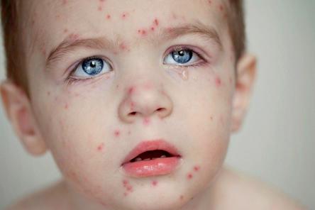 Врачи предупредили россиян об эпидемии кори