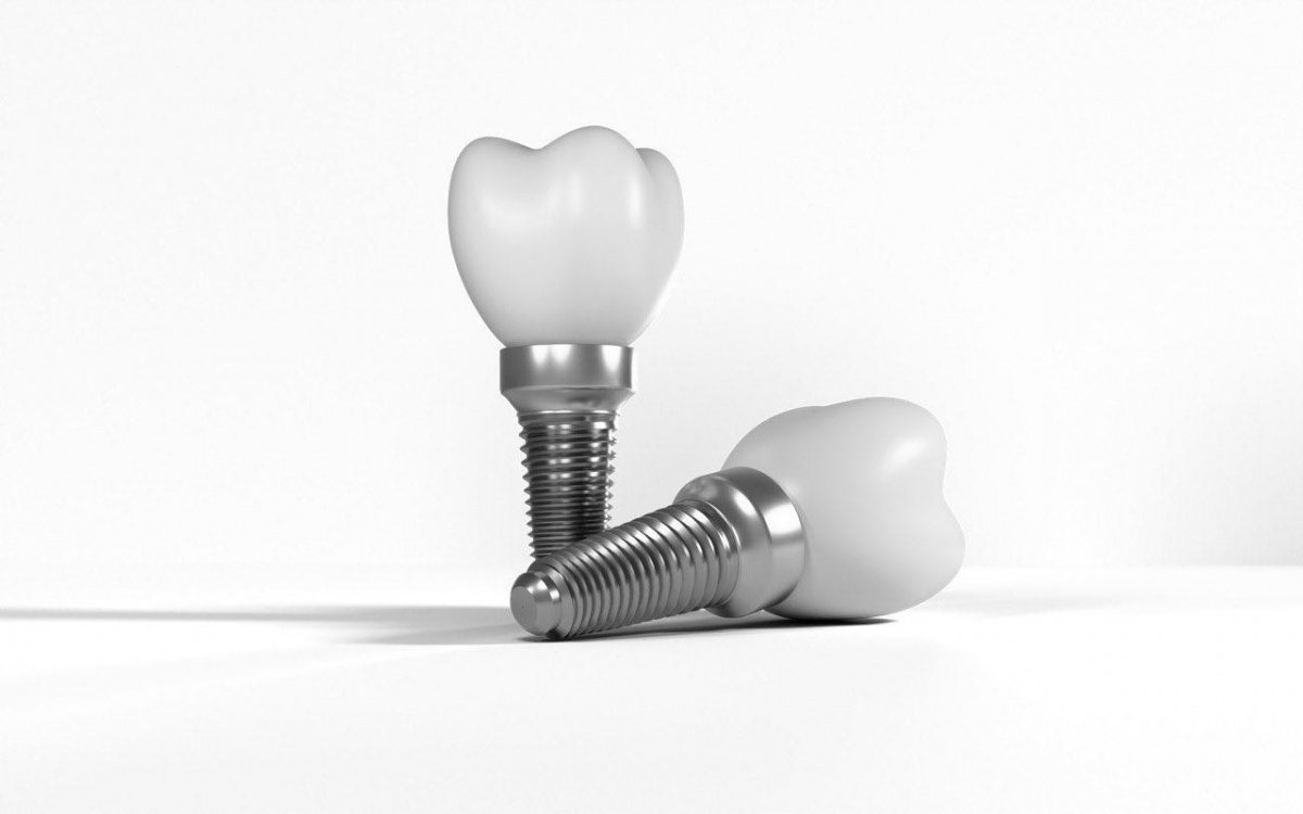 Нижегородцам рассказали все, что нужно знать об имплантации зубов - фото 1